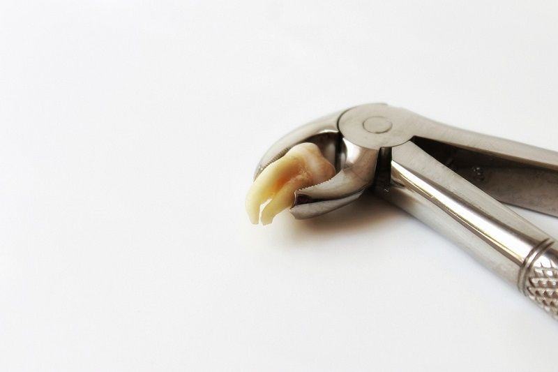 togliere i denti del giudizio