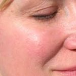 Rosacea:  una vera e propria malattia della pelle