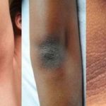 Togliere le macchie scure da ginocchia, gomiti e collo