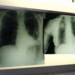 Bpco, ok dell'Ema alla prima terapia con propellente green