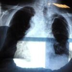 Polmonite, ogni anno in Italia 150mila ricoveri e 9mila morti: i sintomi