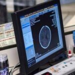 Salute, Padovani (Sin): Longevità aumenta rischio Alzheimer, agire su prevenzione