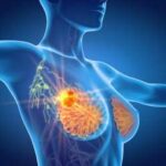 Per cancro seno la cura che arriva dal gelo, Ieo: Verso un futuro no bisturi