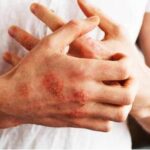 Psoriasi, dopo 4 anni di bimekizumab pazienti con skin clearance completa