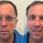 Salute, oculista Appiotti: Lenti Icl efficaci anche in miopie moderate