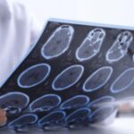 Sclerosi multipla per 144mila italiani, 10% è fuori da percorsi cura e assistenza