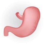 Caldo peggiora sintomi del reflusso, in casi gravi chirurgia opzione risolutiva