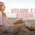 Salute, Giornata vitiligine: al via campagna 'Oltre falsi miti verso nuove possibilità'