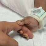Gemelle siamesi separate al Gaslini di Genova: Estubate, respirano da sole