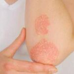 Giornata della psoriasi, Ucb conferma il suo impegno a fianco dei pazienti
