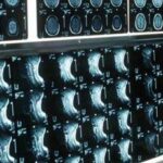 Ipofosfatemia legata all'X, primo bilancio e prospettive su linee guida