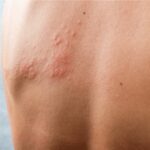Vaccini: 1 over 50 su 2 con cronicità non parla col medico di Herpes Zoster