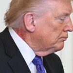 Trump e il collo arrossato, la foto riaccende i dubbi sulla salute del presidente