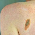 Ogni anno in Italia 2.600 casi ereditari di melanoma, Imi:Prevenzione con test genetici e controlli...