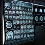 Uno spray nasale ferma l'invecchiamento del cervello, lo studio
